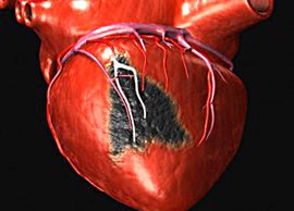 Русский феномен: пациенты не боятся инфаркта