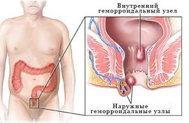 Геморрой