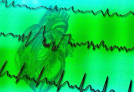 что такое мерцательная аритмия сердца, мерцательная аритмия, ишемическая болезнь сердца, инфаркт миокарда, гипертоническое сердце, причина мерцательной аритмии сердца, предвестник инсульта, тромб