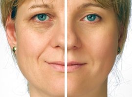 Лазерная коррекция