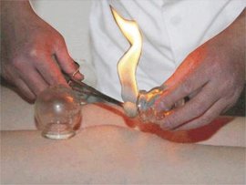 медицинские банки, банки, лечение банками, польза медицинских банок, использование медицинских банок, здоровье, лечение