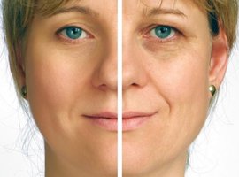 #морщины #морщины вокруг глаз