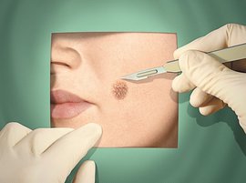 #папилломы #папилломавирус