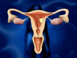 лечения миомы матки, терапия миомы матки, препарат для лечения миомы матки, лечение миомы матки без операции, средства лечения миомы матки, курс лечения миомы матки, улипристала ацетат, консервативное лечение миомы матки