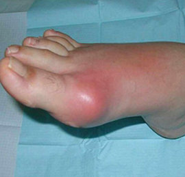 подагра, болезнь, недуг, суставы, мочевая кислота