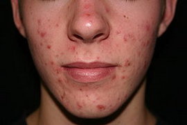 акне, угри, прыщи, угревая сыпь, половое созревание, сальные железы