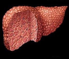цирроз печени, способы избежать цирроза, алкогольный гепатит, лекарство от гепатита, фиброз печени, компенсированный цирроз, декомпенсированный цирроз, печеночная недостаточность, стадии печеночной недостаточности, симптомы начала цирроза печени