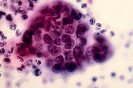 Американские ученые утверждают, что выяснили каким образом витамин E предотвращает появление рака