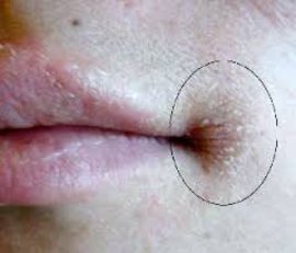 заеда, как избавиться от заед, заеда в уголках рта, появились заеды, лечения заеды, лечение заеды народными средствами, народные средства, средство против заеды, лечить заеды в домашних условиях