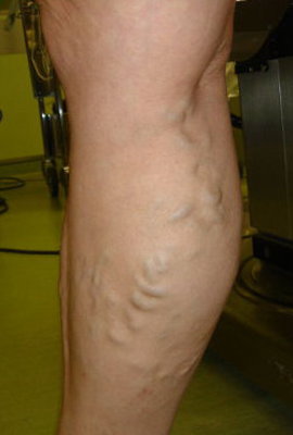 заболеть варикозом вен на ногах, склонности к варикозу вен, развивается варикозная болезнь, застой в венах ног, лечении варикоза вен на ногах, лечить вены на ногах, проявления варикоза вен на ногах