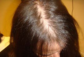 лечить облысение, облысение у женщин, гормональный, причин, выпадение волос, мужскому типу, анализы, гормоны, волос, фолликулы, стресс, инфекция, причину выпадения волос, лечение облысения, причины выпадения волос, лечебные, средства от облысения