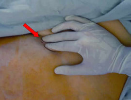 лечить миому матки, миома матки, причина возникновения миомы матки, что такое миома матки, диагностировали миому матки, эндометриоз сейчас успешно лечится, миому матки успешно лечат препаратами, вылечить миому матки 