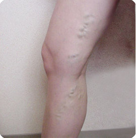 заболеть варикозом вен на ногах, склонности к варикозу вен, развивается варикозная болезнь, застой в венах ног, лечении варикоза вен на ногах, лечить вены на ногах, проявления варикоза вен на ногах