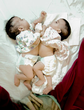 сиамские близнецы, Индия, операция