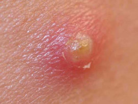 фурункул, фурункулез, выдавливать фурункулы, фурункулах верхней губы, фурункуле лица, осложнениям фурункулов, Как лечить фурункулы в домашних условиях, лечения одиночного фурункула, фупункула на лице, фурункулах на шее, ихтиол 