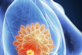 мастопатия