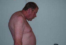 анкилозирующий спондилоартрит, лечение болезни Бехтерева, симптом Скотти, лекарства от болезни Бехтерева, лекарствами против анкилозирующего спондилоартрита, преднизолон, кортикостерон, гимнастика при болезни Бехтерева, народные средства