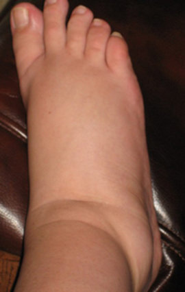 отеки, отеки глаза, отек квинке, отек лица, причины отеков, отек под, отек легких, отеки под глазами, как снять отек, лечение отекоа, отек носа