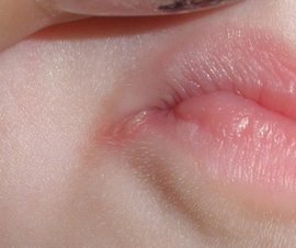 заеды, хейлиты, заеда в уголках рта, причины заеды в уголках рта, лечение заед на губах, народные средства лечения заеды в уголках рта, народные рецепты, средство против заеды