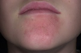 экзема, экземой руки, истинная экзема, микробная экзема, микотическая экзема, себорейная экзема, варикозная экзема, чем и как лечить экзему, метода лечения экземы, для лечения экземы, при экземе, народные средства лечения экземы, лечения экземы на руках