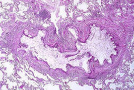 астма, бронхиальная, дети, ребенок, профилактика, лечение, заболевание, лекарство, врач, грудного, аллергия, закалять, болезни, гипоаллергенного, бронхиальная астма