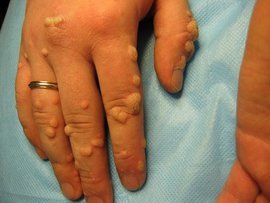 бородавки, лечение бородавок, причиной бородавок, возникновения бородавка, методом лечения бородавок, методов удаления бородавок