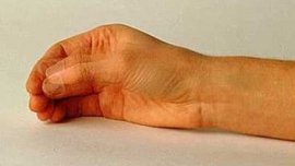 болезнь паркинсона, болезнь паркинсона симптомы, болезнь паркинсона лечение, болехнь паркинсона симптомы и лечение