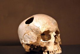 Трепанацию черепа делали еще в древности?