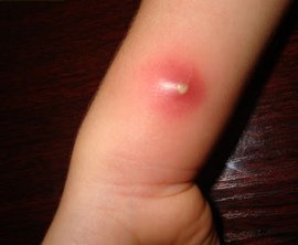 лечение фурункула, фурункул, прыщ на носу, фурункул в носу, причины, лечить фурункул в носу, самостоятельно, вскрытие фурункула в носу, лечение фурункула в носу