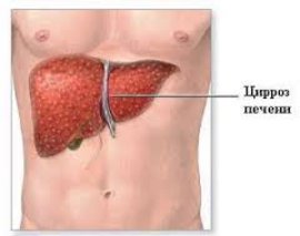  рак печени, злокачественных опухолей, диагностика рака печени, лечить рак печени, поражений печени, маркеров раковых опухолей, лапароскопическая операция, опухоли печени, операции на печени