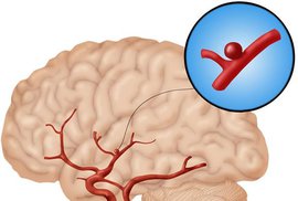 Аневризма – 'ласковый убийца' в сфере неврологии