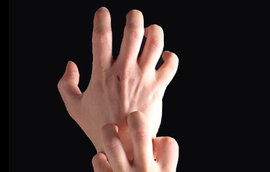 экзема, способах лечения экземы, причины возникновения экземы, истинной экземе, гиперемия кожи, дисгидротической экземе кистей рук, микробной экземе, себорейная экзема, лечения экземы, для лечения экземы, препараты глюкокортикостероиды, симптомы экземы